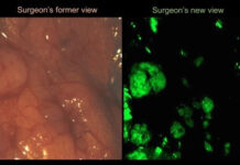 Công nghệ mới trong phẫu thuật ung thư buồng trứng