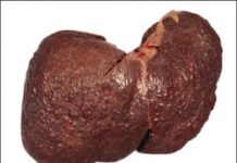 Xác định chính xác dấu hiệu của bệnh ung thư gan