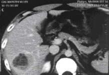 Ung thư gan: có thể chữa được nếu phát hiện sớm