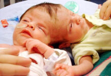 Cặp song sinh dính liền đầu có thể nhìn bằng mắt người kia, đọc ý nghĩ của nhau bây giờ ra sao?