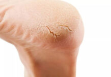 Soi bàn chân mà thấy dấu hiệu này, cẩn thận gan suy hỏng, mất chức năng từ bao giờ