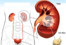 Tất cả những điều bạn cần biết về bệnh sỏi thận