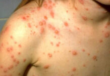 Những thực phẩm nên ăn và nên tránh khi bị thủy đậu