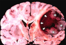 Phát hiện ra hai loại protein gây căn bệnh ung thư não