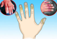 Cách chữa trị cho người bị bỏng lạnh