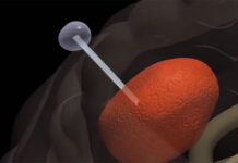 Chữa u não bằng công nghệ “câu” tế bào ung thư