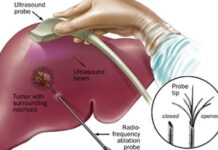 Việt Nam điều trị thành công ung thư gan bằng hạt vi cầu phóng xạ