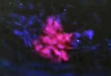 Australia: Thuốc mới giúp tế bào ung thư phát sáng