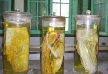 Formaldehyde gây ung thư máu và bạch cầu