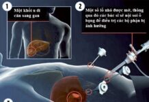 Chìa khóa ngăn ung thư đại tràng tấn công gan