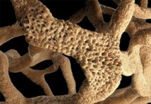 Thói quen thường gặp gây loãng xương người trẻ nên biết để thay đổi