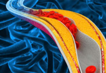 Nghiên cứu cho thấy nhiễm độc kim loại nặng làm tăng nguy cơ mắc bệnh tim mạch