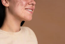 Mụn trứng cá có thể mang lại lợi ích bất ngờ cho quá trình lão hóa