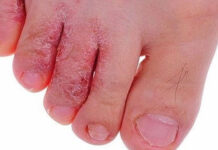 Mẹo trị nước ăn chân cực nhanh và an toàn