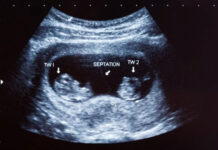 Bệnh viện Phụ sản Hà Nội: Công bố ca song thai cùng trứng cực kỳ đặc biệt, thế giới mới ghi nhận 1 trường hợp