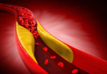 Lý do người trẻ cũng bị máu nhiễm mỡ