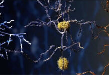 Tìm ra thủ phạm tiềm năng mới của bệnh Alzheimer