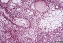 Biến tế bào gốc thành cỗ máy chữa ung thư