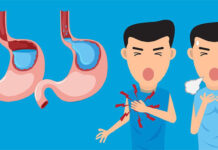 Trào ngược dạ dày thực quản là gì?