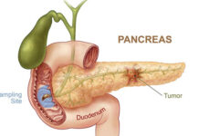 Phương pháp mới chẩn đoán sớm bệnh ung thư tụy