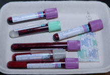 Phát hiện ung thư buồng trứng sớm nhờ thử máu thường xuyên