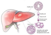 Công bố phát hiện quan trọng về bệnh ung thư gan