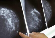 Điểm tương đồng giữa ung thư vú và buồng trứng