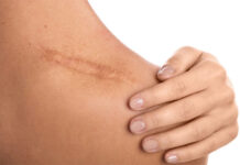 Các nhà khoa học Bỉ phát hiện đột phá về quá trình liền sẹo