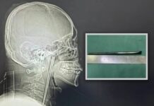 Người đàn ông sống 8 năm với chiếc đũa trong cổ họng và cái kết khiến cộng đồng mạng không thể tin nổi
